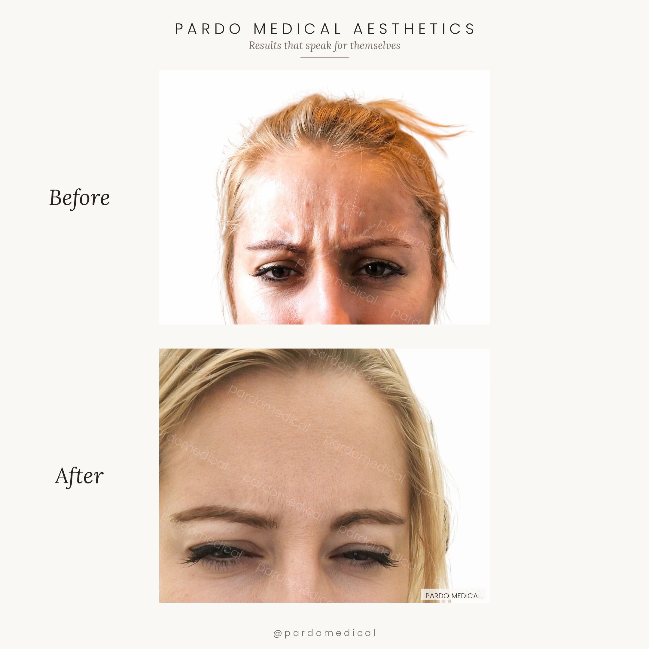 Anti-wrinkle treatment before and after - forehead, glabella, and crow's feet