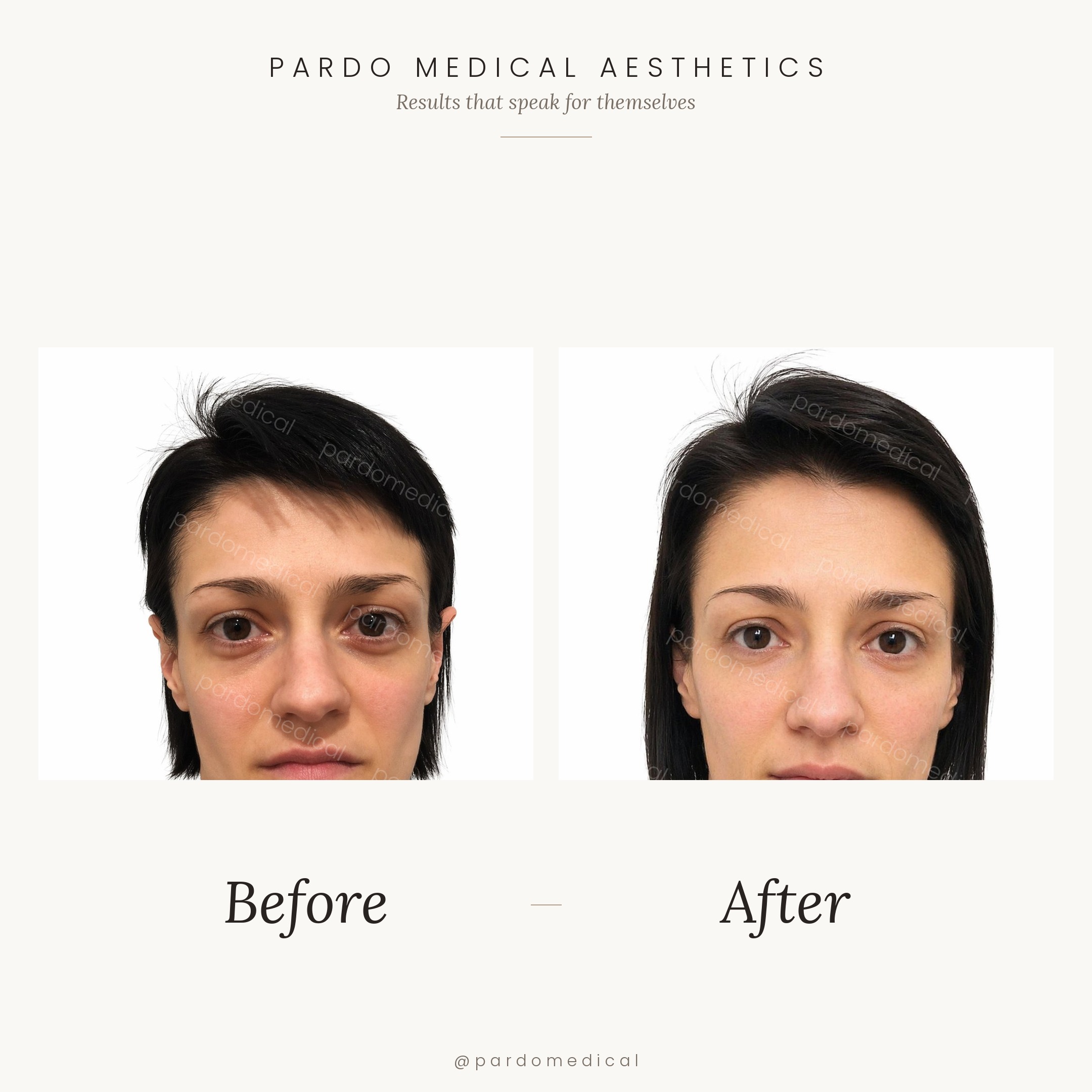 Tear trough and cheek filler before and after - under-eye hollowing corrected