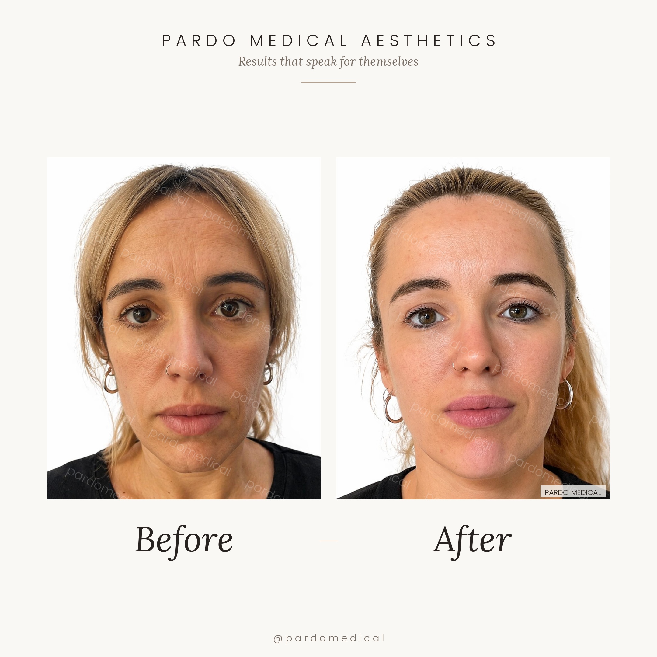 Full facial contouring before and after - cheek volumisation, forehead fillers, tear troughs, and chin augmentation