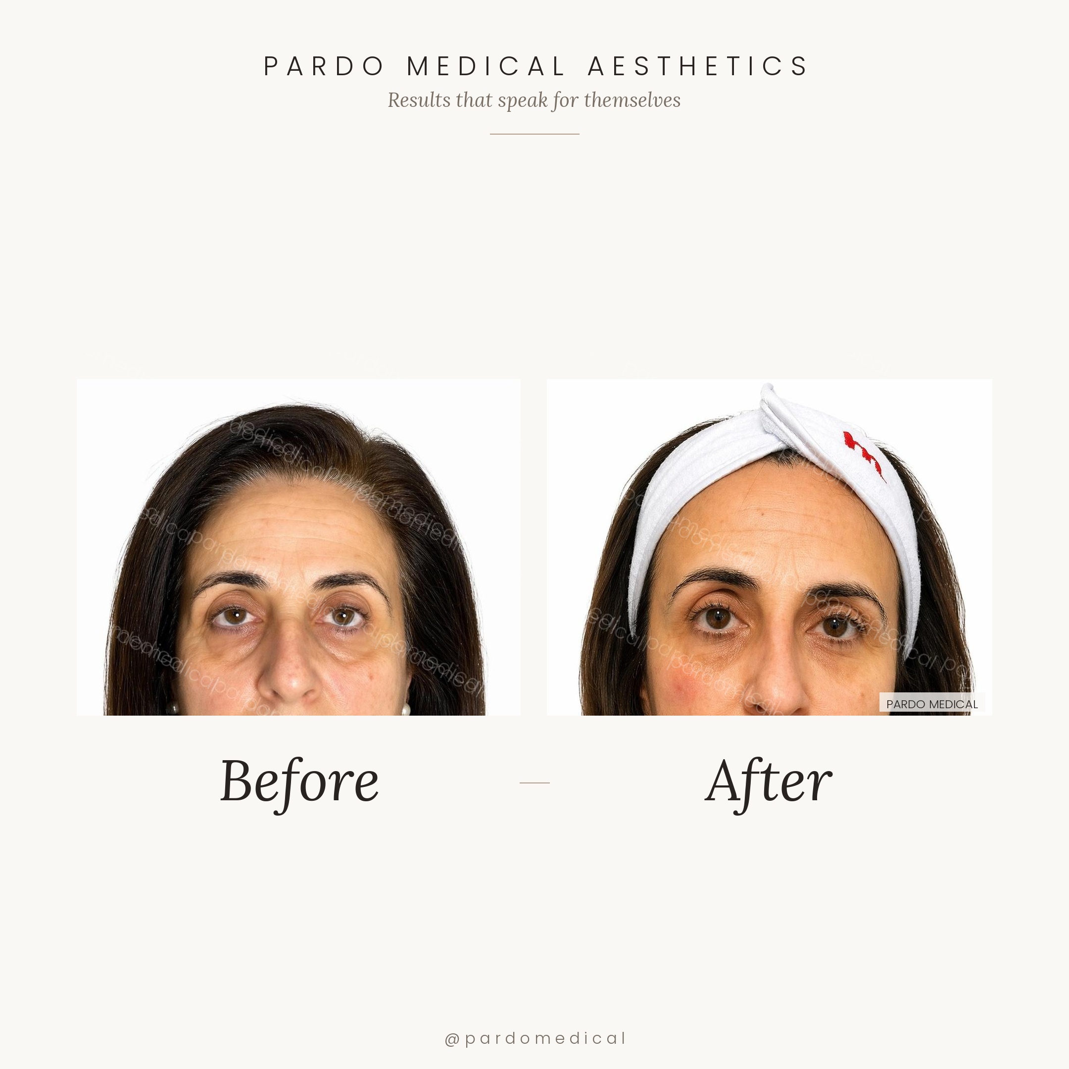 Tear trough filler before and after - refreshed under-eye area