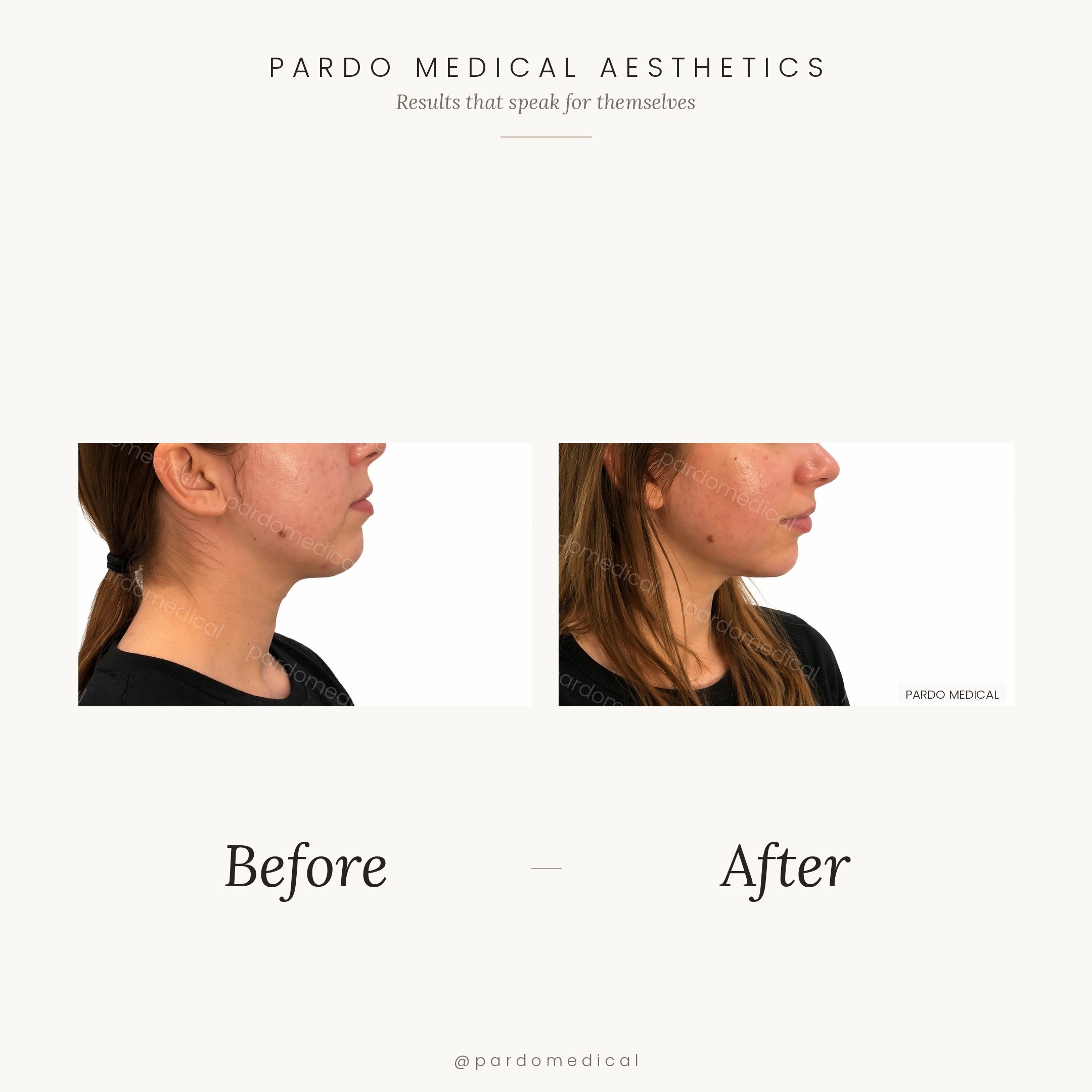 Jawline and chin filler before and after - improved lower face definition