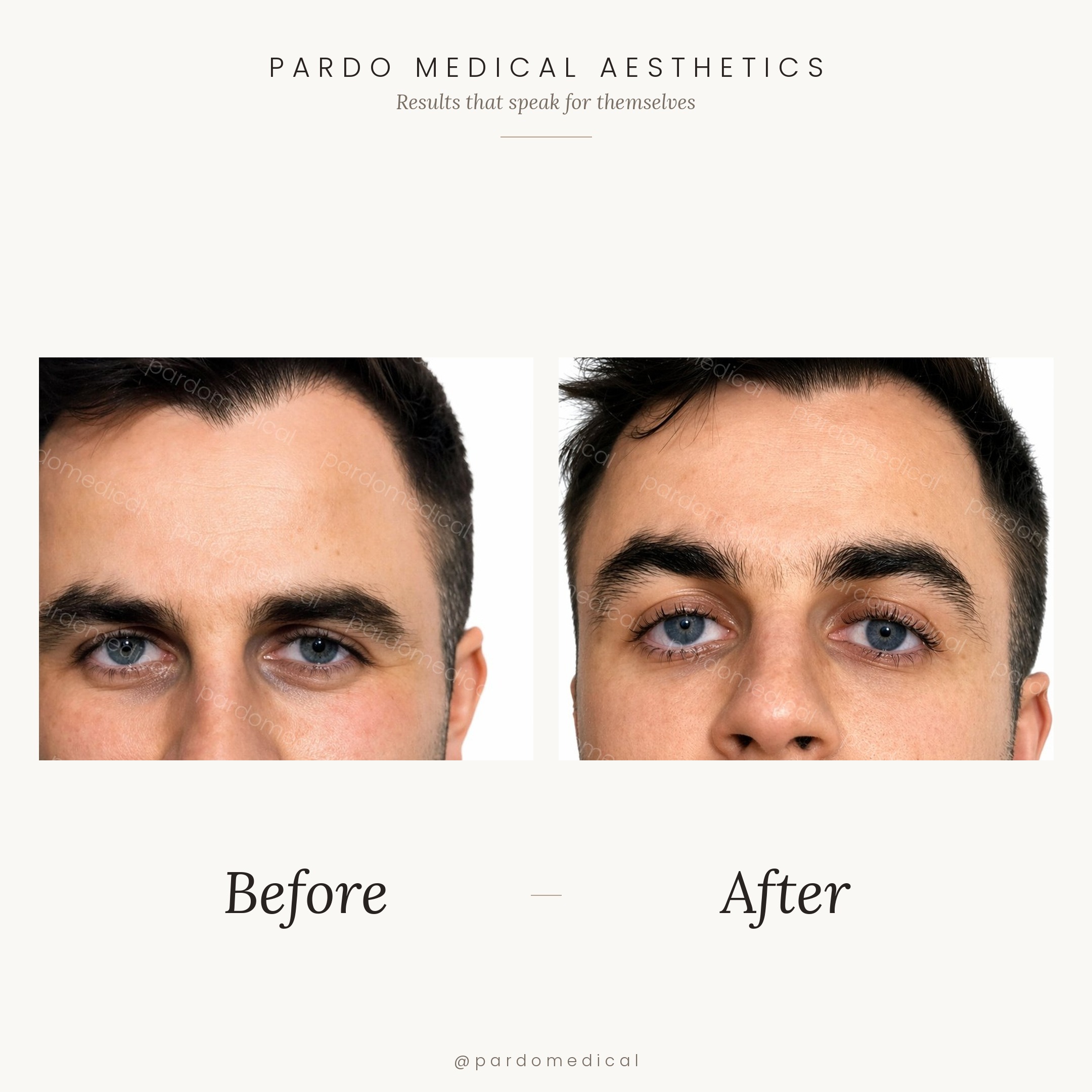 Male tear trough filler before and after - reduced under-eye hollowing