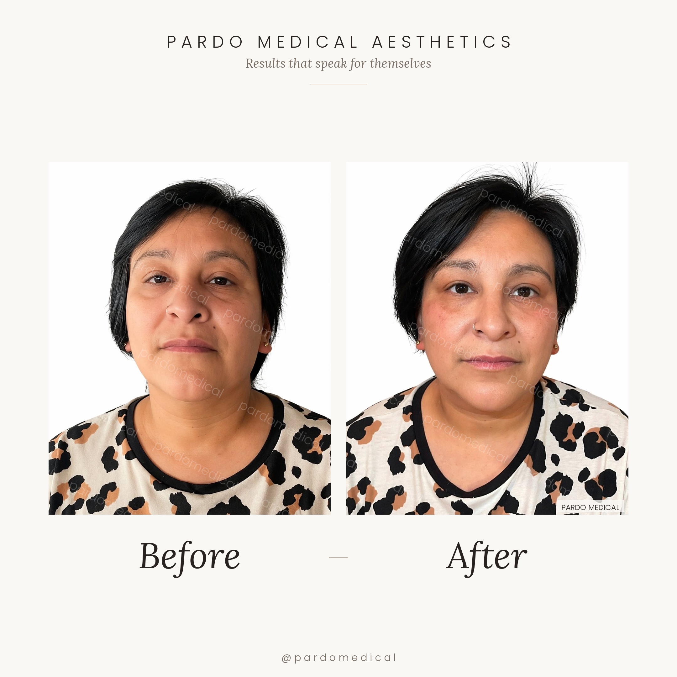 Full facial contouring before and after - tear troughs, cheeks, nasolabial folds, and chin augmentation