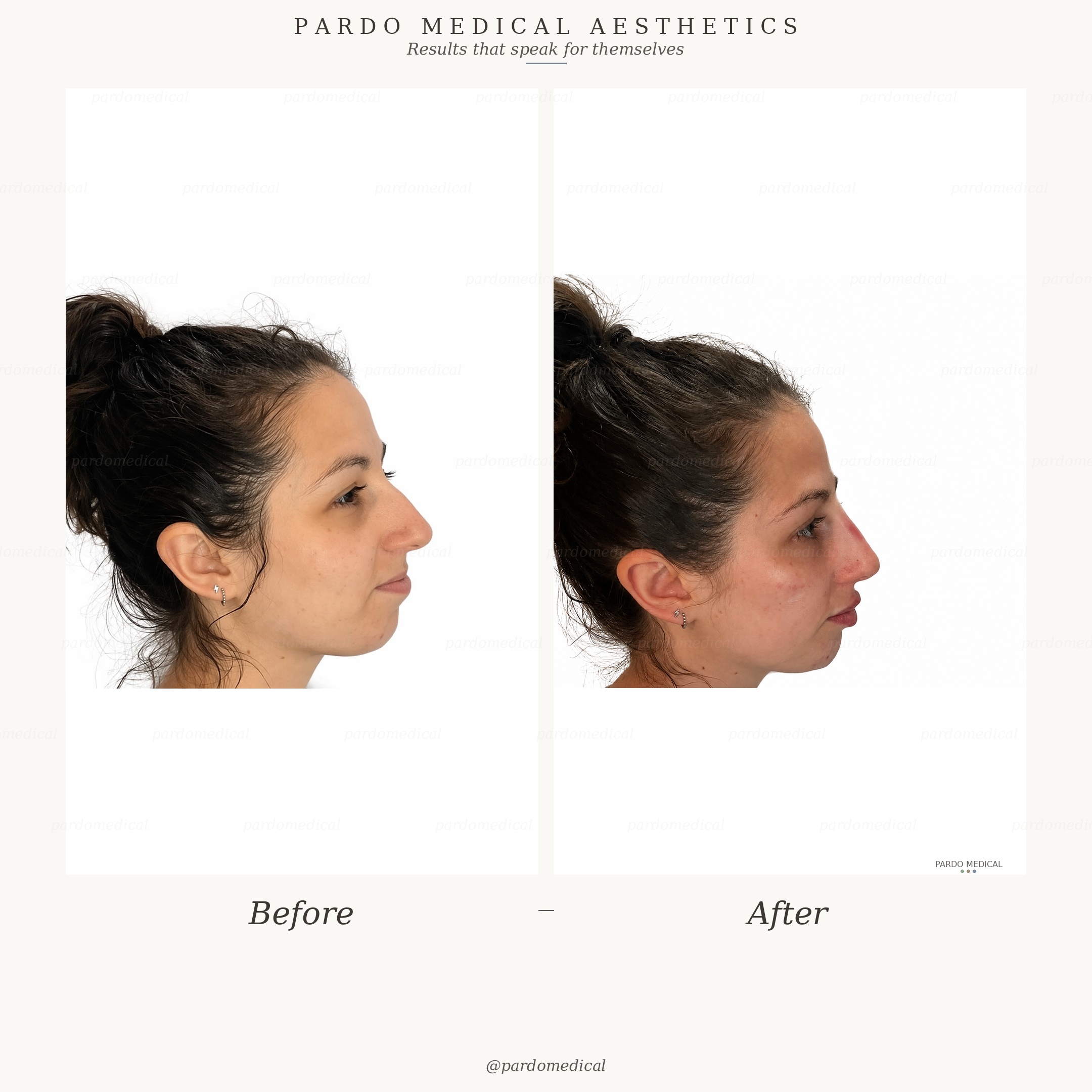 Full facial contouring before and after - profile view showing tear troughs, cheeks, rhinoplasty, chin and jawline remodellation